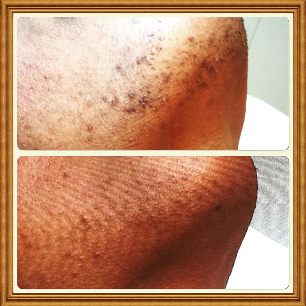 Gallery | Miami, FL | Barba Skin Clinic